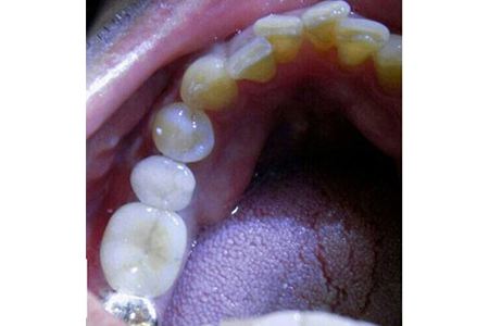 Single implant #30 after Image