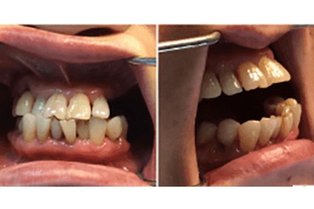Fixed denture before Image