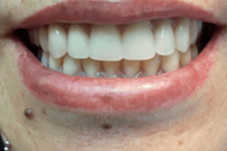 Fixed denture after before Image