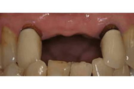 Implant & crown before Image