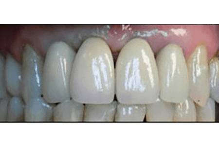 Implant & crown after Image