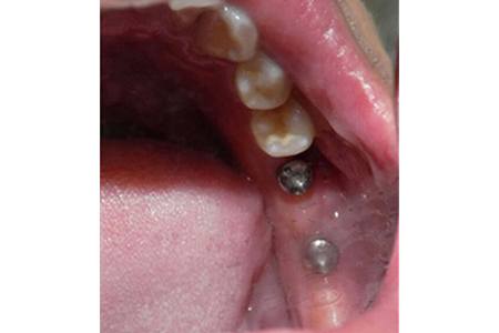Implants #18 & #19 before Image