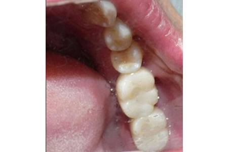 Implants #18 & #19 after Image