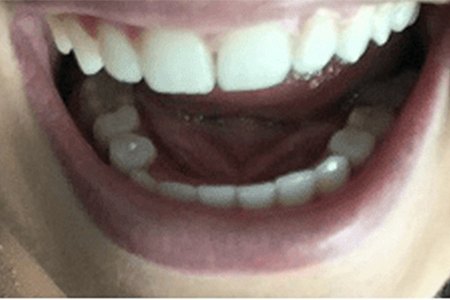 partial after Image