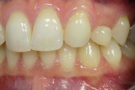 implant on #11 before Image