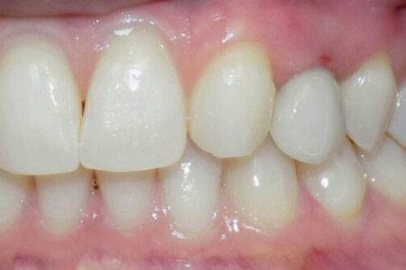 implant on #11 after Image