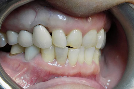 cosmetic crown #6 before Image
