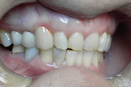 cosmetic crown #6 after Image