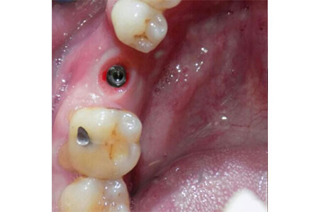 cosmetic implant #30 before image