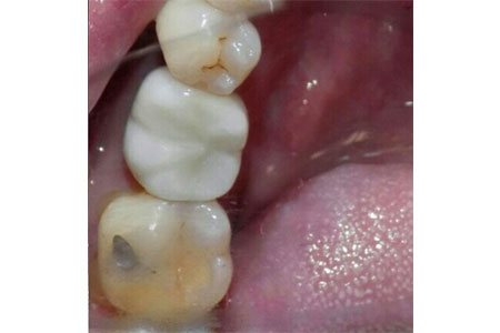 cosmetic implant #30 after image