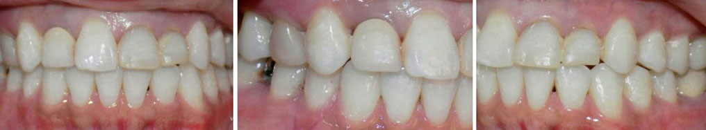 before veneers #7-10 Image