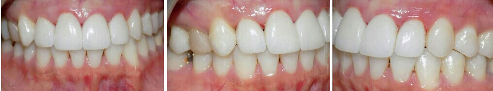 after veneers #7-10 Image