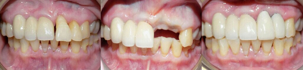 implant #9-10 Image