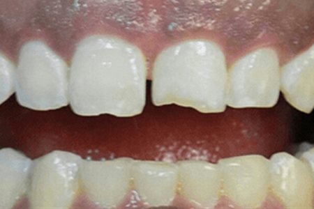 chipped tooth before image