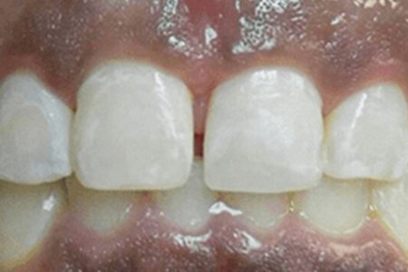 chipped tooth after image