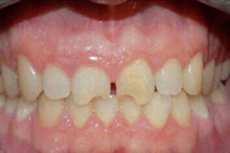 chipped tooth before image