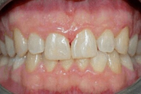 chipped tooth after image