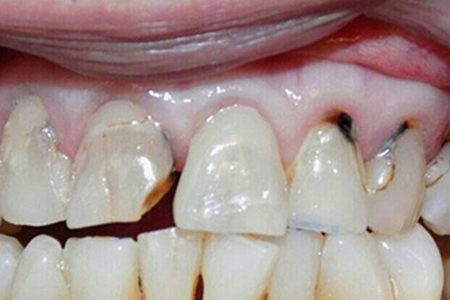 composite restoration #8-11 before image
