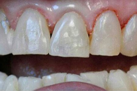 composite restoration after image