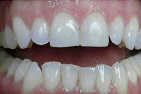 facial filling after image
