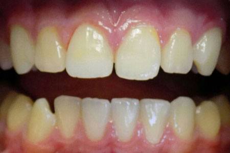 restoration on #4 before image