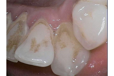 scaling & root planing before image