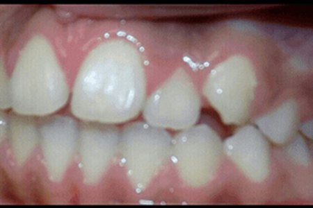 traditional braces before 2015 Image