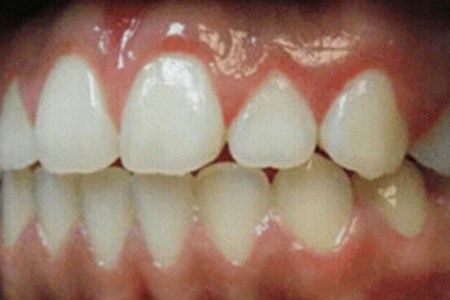 traditional braces after 2017 image