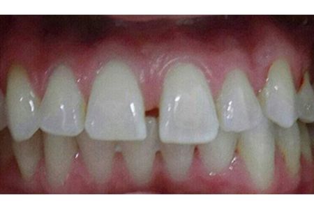 invisalign before may 2016 image
