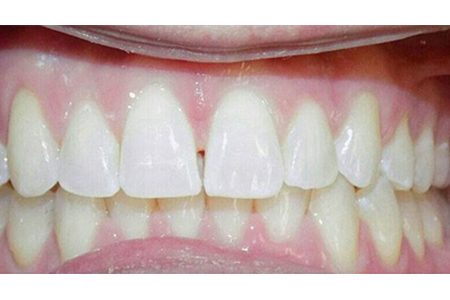 invisalign after november 2017 image