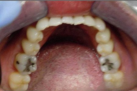 invisalign before image