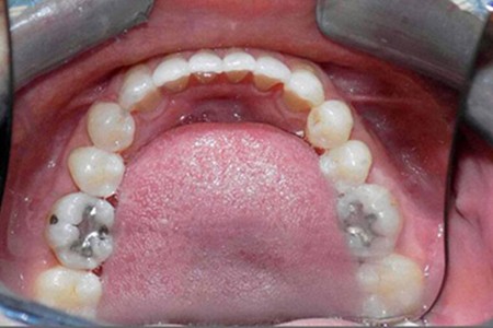 invisalign after image