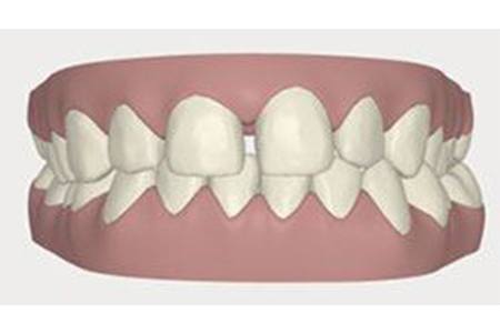 invisalign before 2016 image