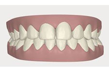 invisalign after 2017 image