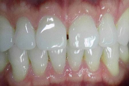 invisalign before 2016 image
