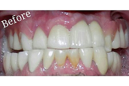 Crowns and Implants before Image