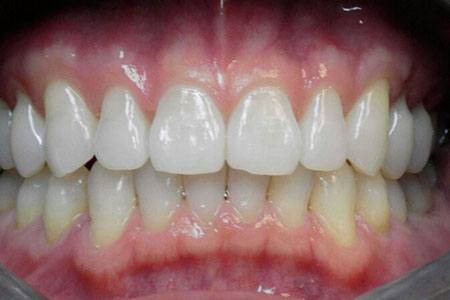 invisalign after 2017 image