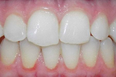 invisalign before october 2016 image