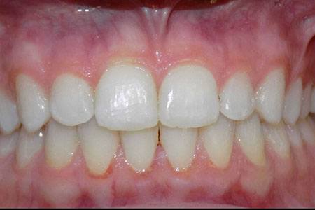 invisalign after october 2017 image