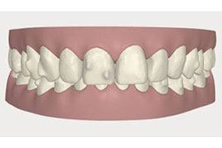 invisalign before october 2016