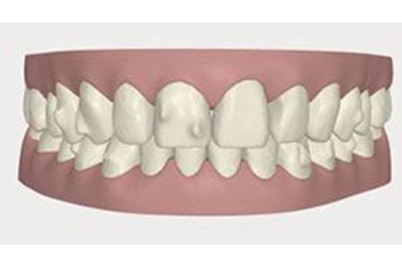 invisalign after october 2017