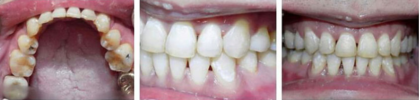 after traditional braces image