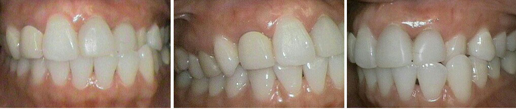 before traditional braces 2015 image
