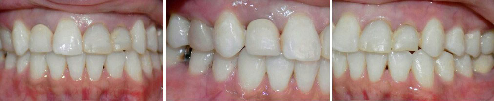 after traditional braces 2018 image