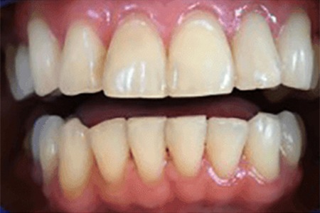 whitening with zoom quickpro before image