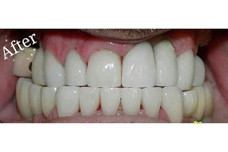 Crowns and Implants after Image