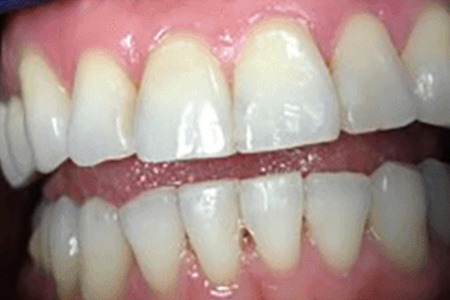 whitening with zoom quickpro after image
