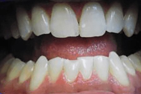 whitening with zoom quickpro before image