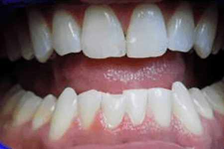 whitening with zoom quickpro after image