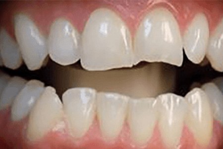 whitening using zoom whitespeed before image